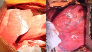 Transplantation Révolutionnaire : Des Médecins Chinois Implantent avec Succès un Poumon de Porc chez un Patient en Mort Cérébrale