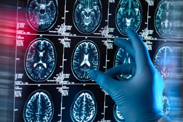 Alzheimer : Le Sommeil Profond, un Bouclier Cérébral Naturel selon une Étude