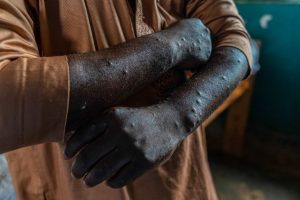 Deux nouveaux cas de Mpox confirmés à La Réunion : l'ARS active la vaccination préventive